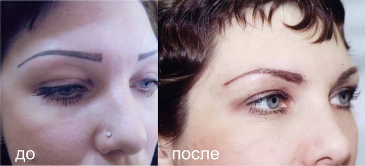 БЫЛО ПРЕДВАРИТЕЛЬНОЕ УДАЛЕНИЕ ЛАЗЕРОМ