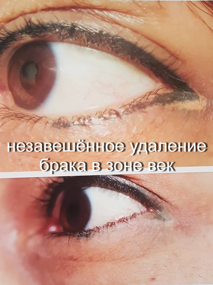ИСПОЛЬЗОВАНИЕ НЕОДИМОВОГО ЛАЗЕРА