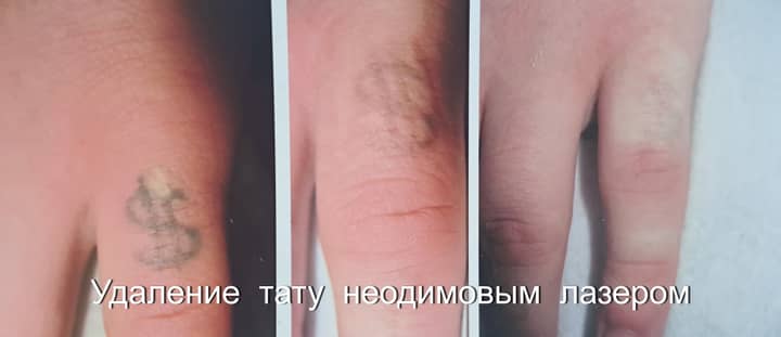 2 ПРОЦЕДУРЫ НЕОДИМОВЫМ ЛАЗЕРОМ
